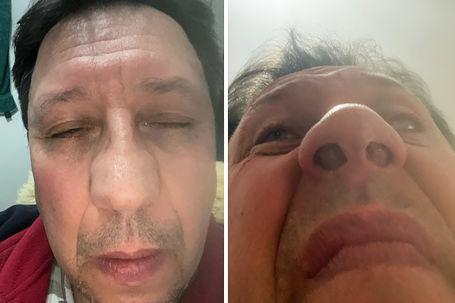 Four years on, Vladimir waits for nose surgery