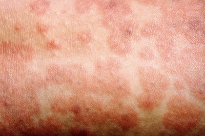 Measles case confirmed in ACT after overseas travel