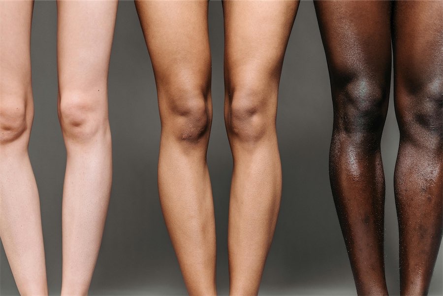 Kneecap link to debilitating joint disease